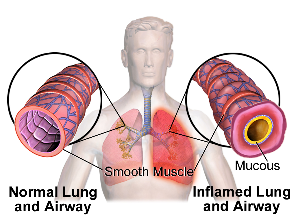 Illustration comparing a normal relaxed bronchiole with an asthmatic bronchiole showing a narrowed lumen, thickened wall, mucus and contracted smooth muscle.
