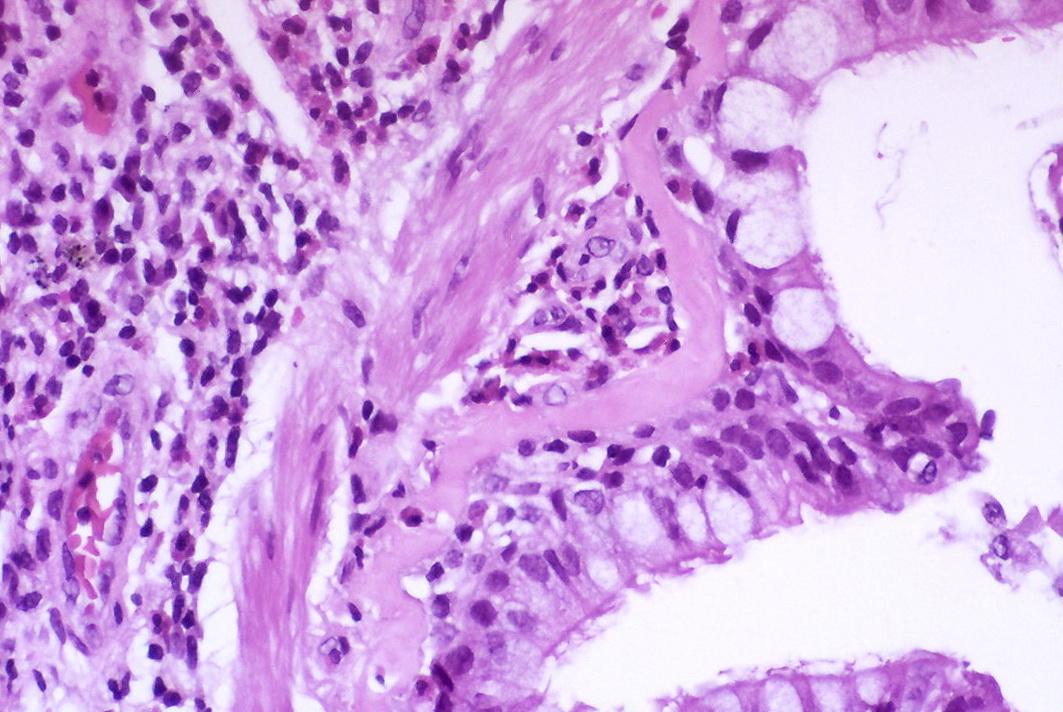 Microscope view of an asthmatic airway showing goblet cell hyperplasia, thickened basement membrane and inflammatory infiltrate in the wall.