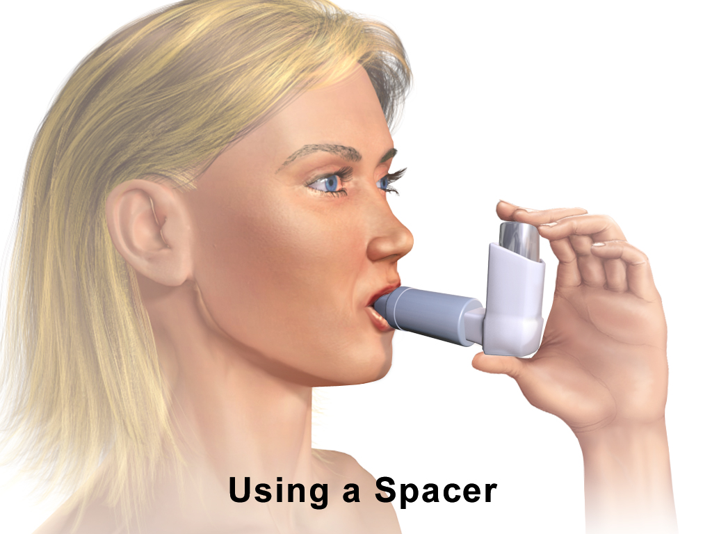 Illustration of correct metered-dose inhaler technique with a spacer device.