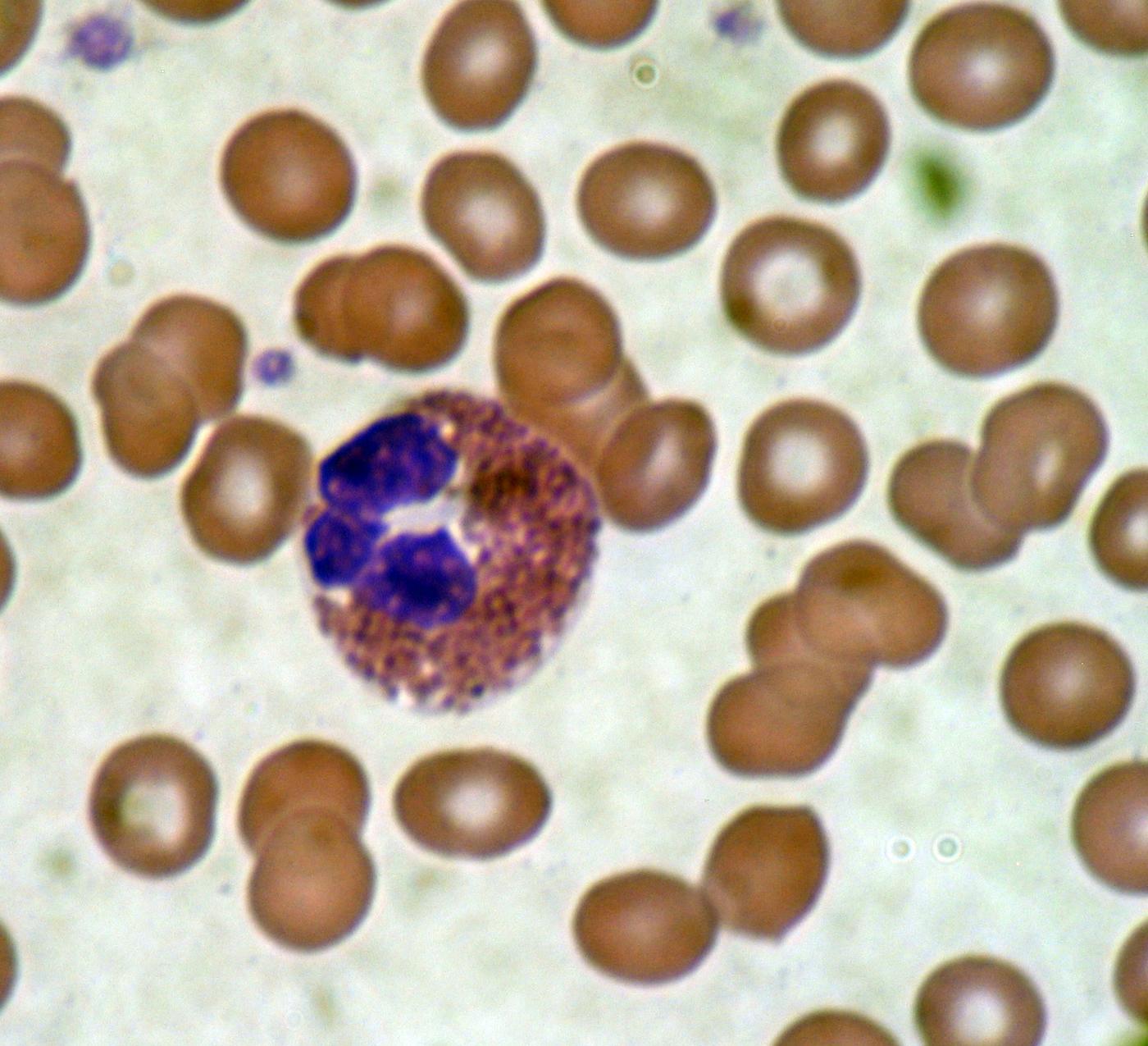 Microscope image of an eosinophil from a peripheral blood smear showing its characteristic bilobed nucleus and pink granule-staining cytoplasm.