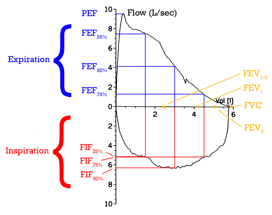 Spirometry flow-volume loop and spirogram tracing showing the obstructive pattern of asthma with improved post-bronchodilator flow.