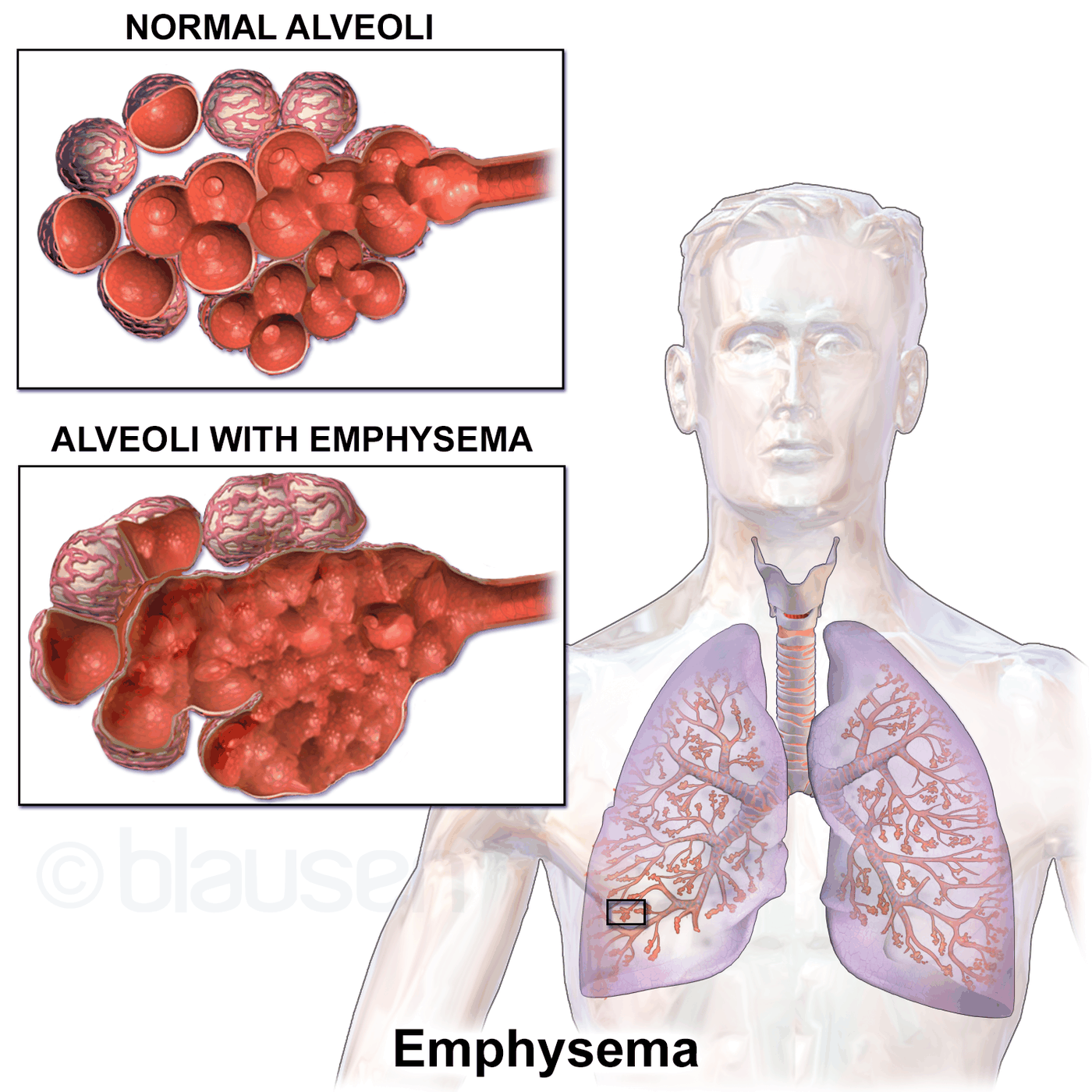 Illustration comparing healthy round alveoli with the enlarged, coalesced air spaces of emphysema.