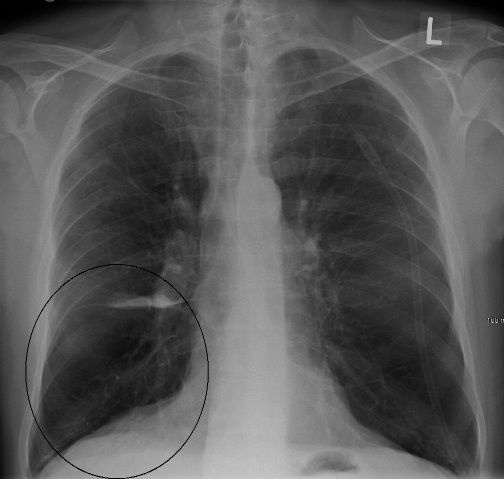 Frontal chest X-ray showing hyperinflated lungs with flattened diaphragms and a small narrow heart, typical of severe COPD.