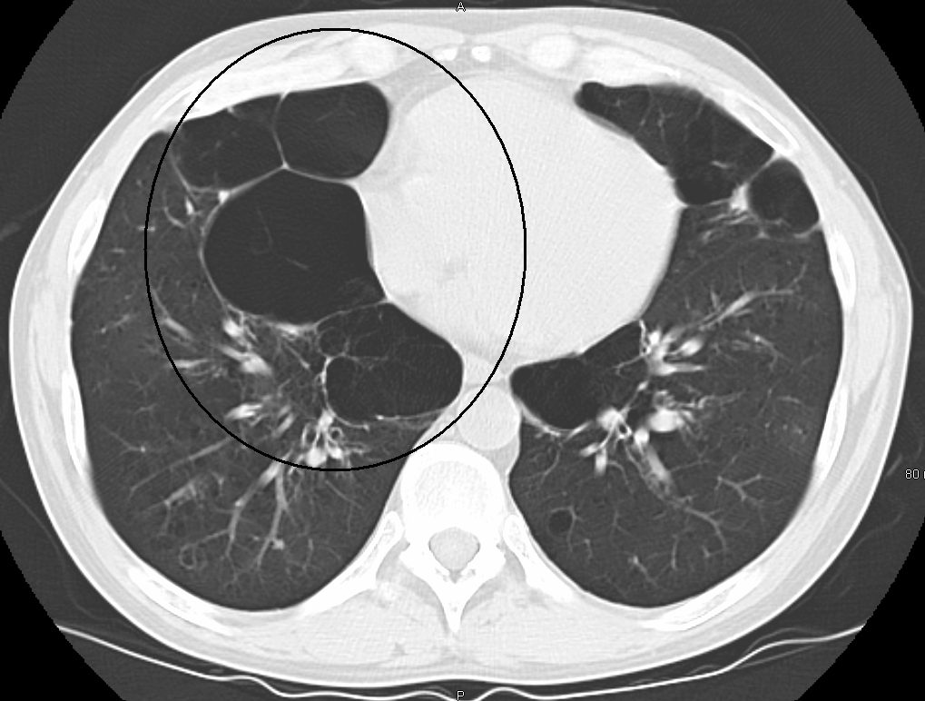 Cross-sectional chest CT scan highlighting bullae (dark air spaces) in the upper lobe from emphysema.