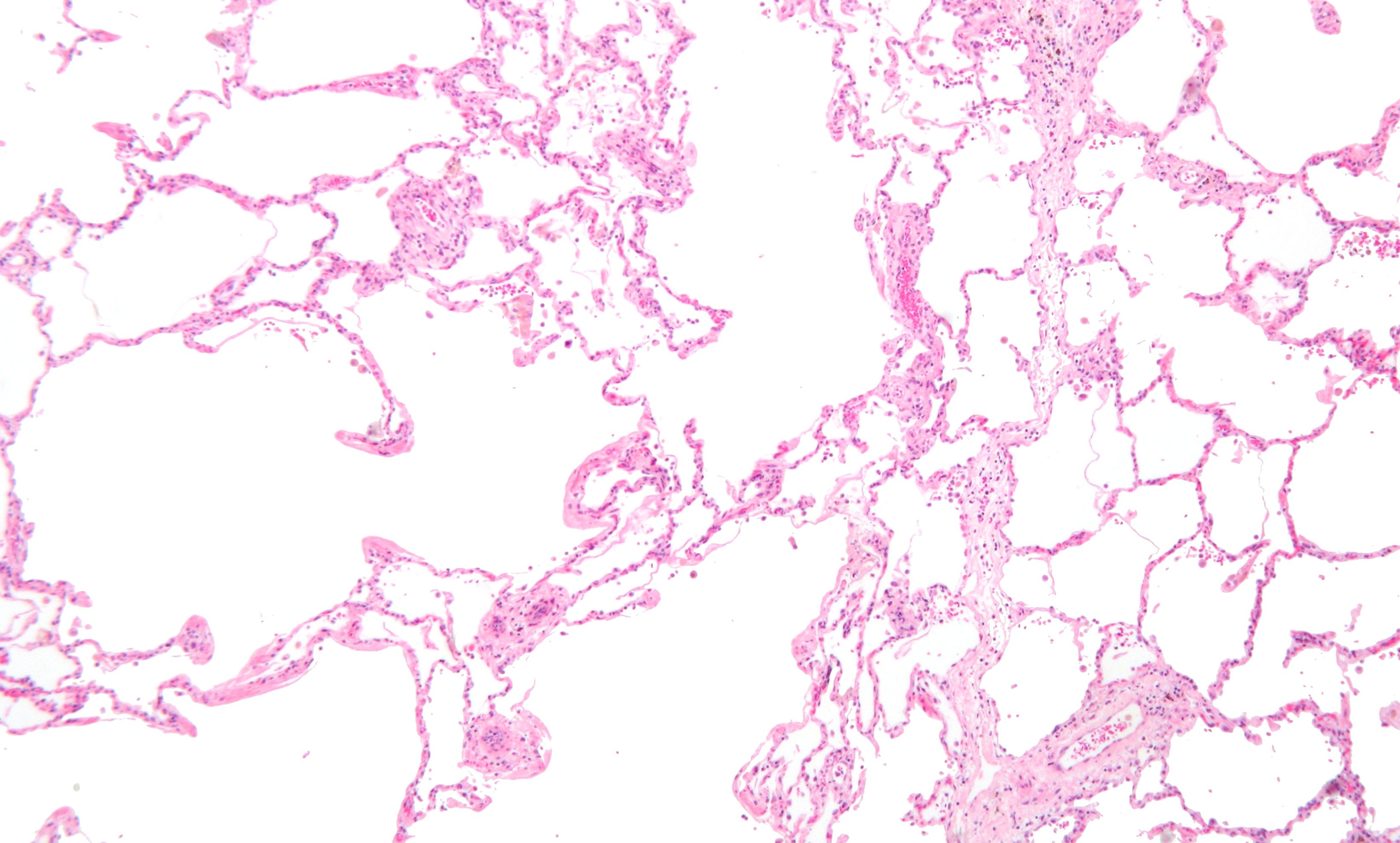 Microscope view of emphysematous lung tissue showing enlarged air spaces and destroyed alveolar walls.