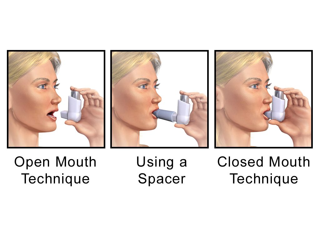A metered-dose inhaler (puffer) with a mouthpiece for delivering inhaled COPD medication.