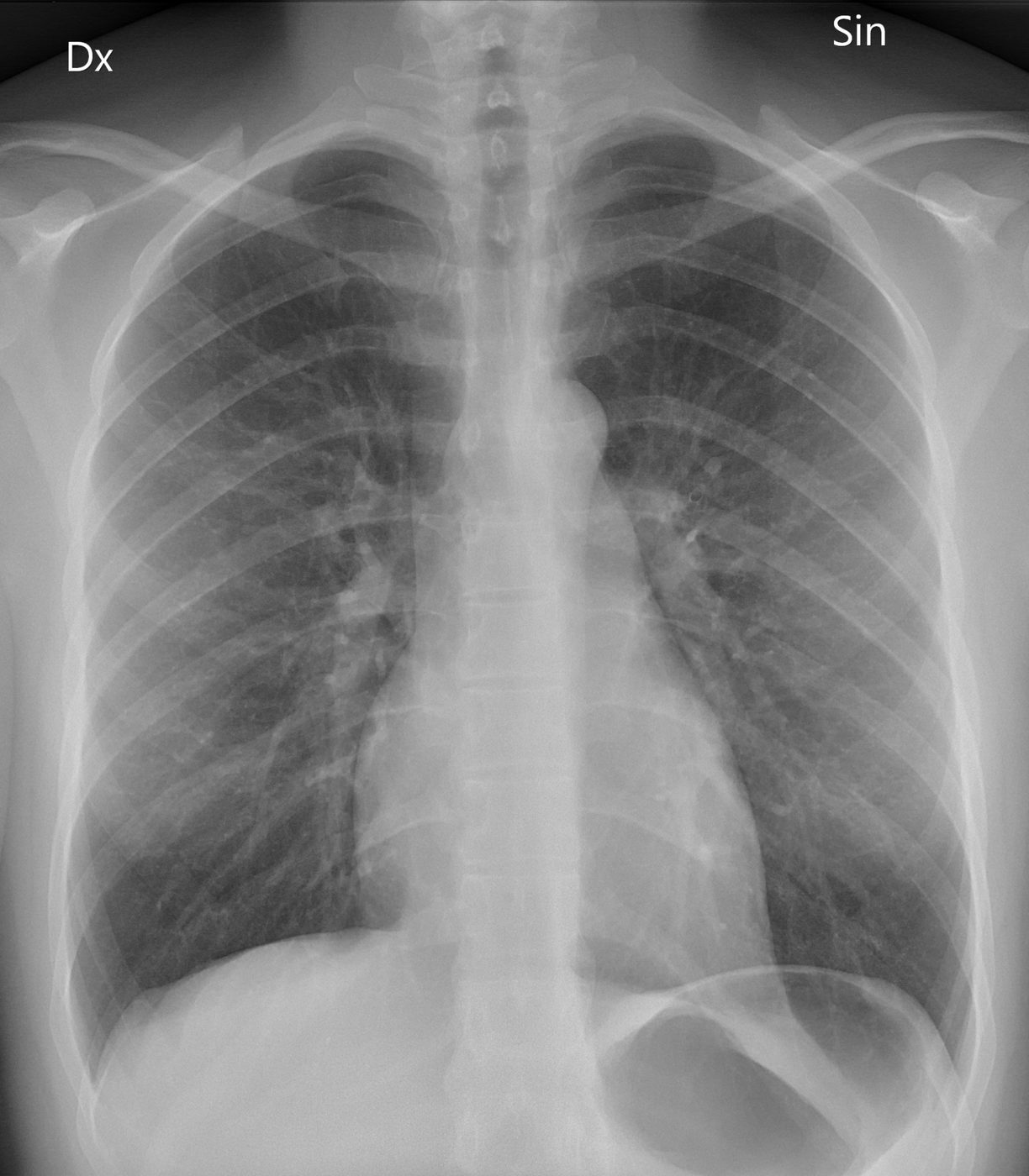Frontal chest X-ray of normal healthy lungs with domed diaphragms and a normal heart size.